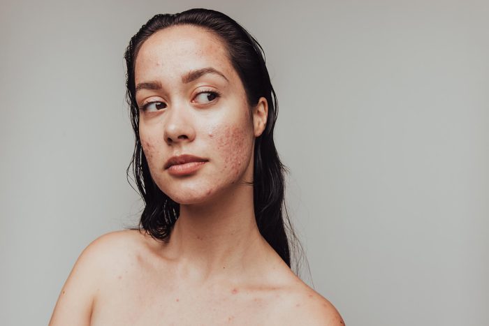 Woman with acne on her face because of vegan protein