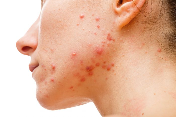 Vegan protein powder acne on face